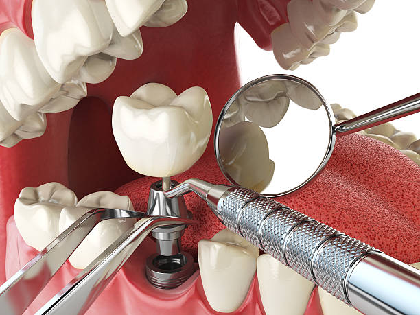 Best Emergency Wisdom Teeth Removal in Wickerham Manor Fisher, PA